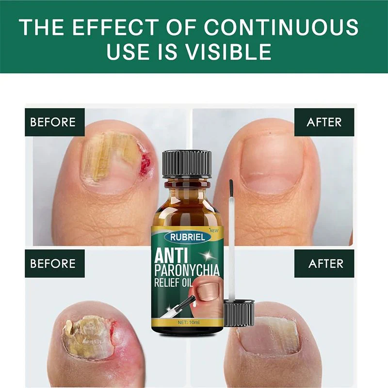 Anti Paronychia Relief Oil - Buy 1 Get 1 FREE🔥