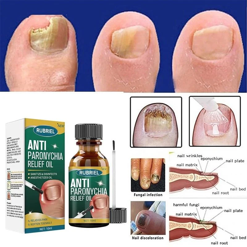 Anti Paronychia Relief Oil - Buy 1 Get 1 FREE🔥